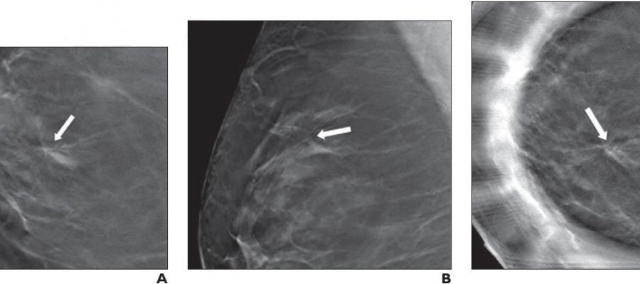 Architectural Distortion On Digital Breast Tomosynthesis With Nonmalignant Pathology